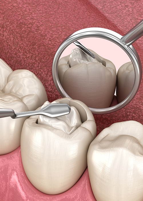 3D image of a tooth receiving a dental filling.